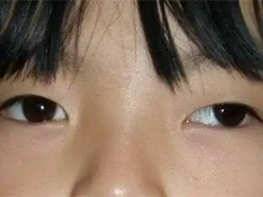 先天性共同性外斜视的症状和图片 - 有来医生