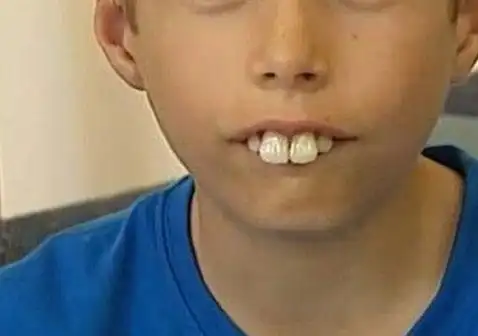 龅牙图片真人图片