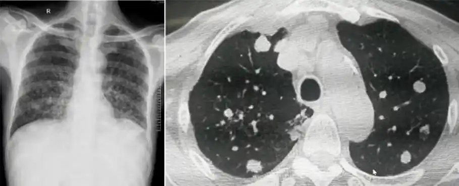 【高尚科普】支气管肺炎_小叶_病变_炎症