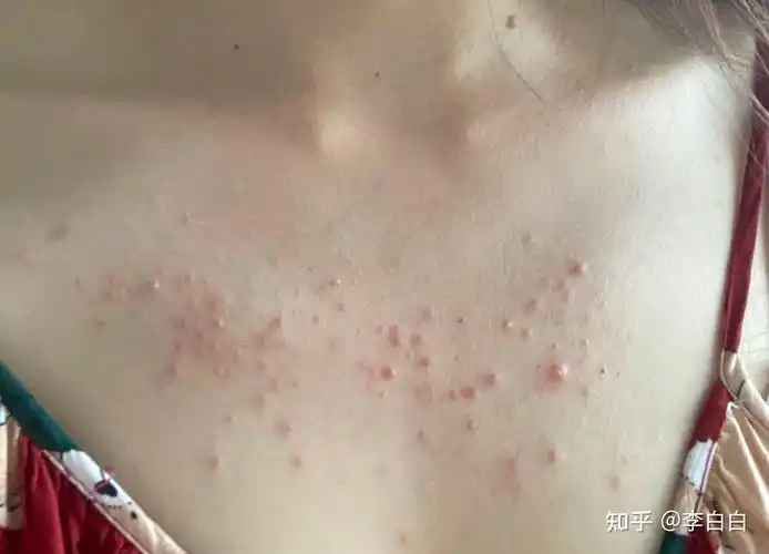 胸前突然长一大片小小的痘痘