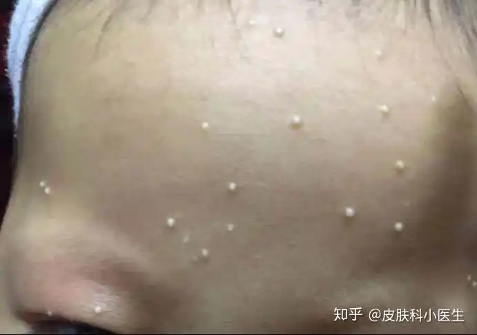粟丘疹案例 - 知乎