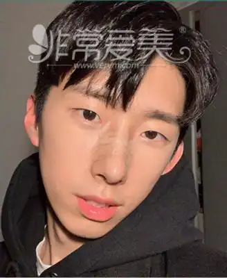韩国模特整形亲身经历告诉你男生隆鼻后会帅多少