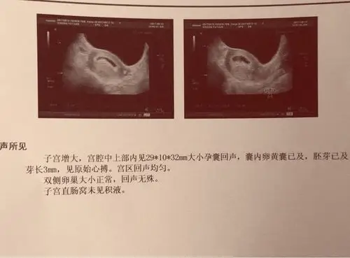 怀孕多久可以做b超看宫内宫外的