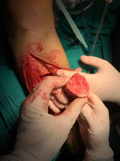 胫骨慢性骨髓炎,胫骨延长搬运术