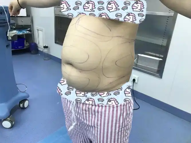 【人鱼体雕腰腹吸脂】