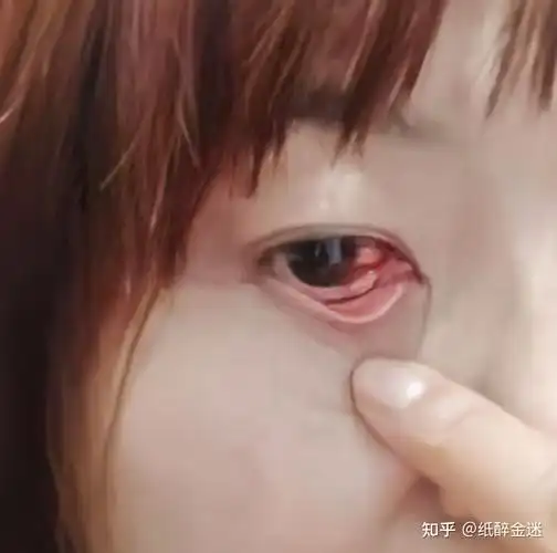 今天早上突然发现眼睛的眼白长了一个血块,是很严重吗? - 知乎
