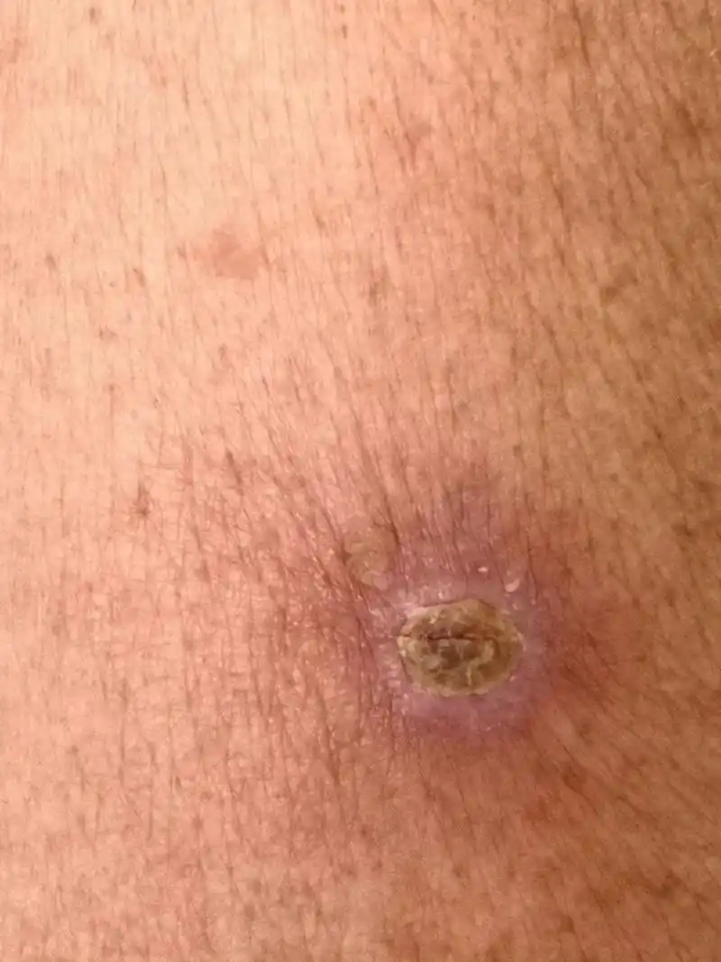 上肢皮肤增生物,活检高分化鳞状细胞癌.