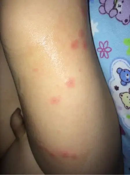 宝宝食物过敏红疹图片,皮肤过敏症状,宝宝食物过敏图片_文秘苑图库