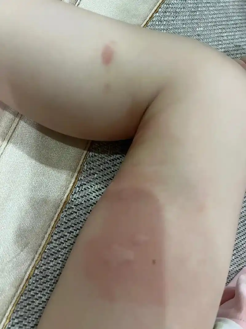 就等我充个电动车就被蚊虫咬成这样,十几个包,都