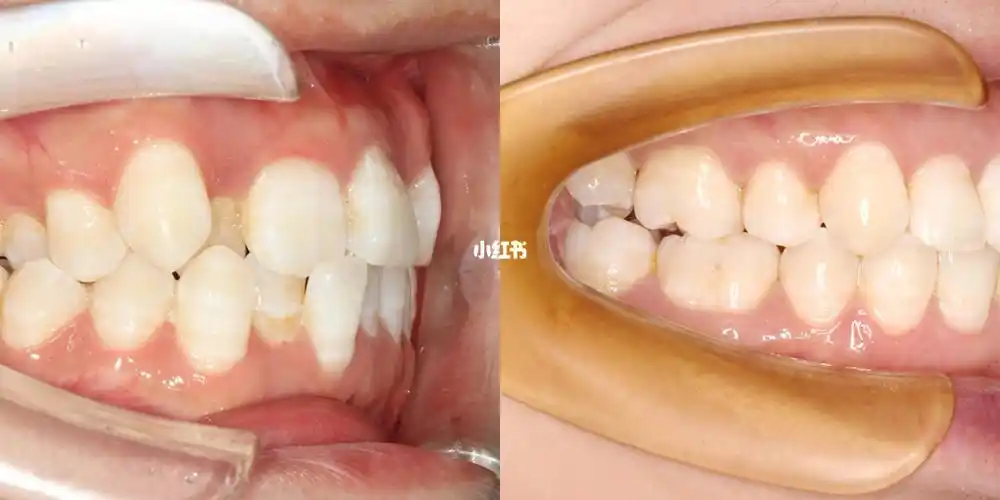 清洁_刷牙_牙齿矫正_郑州_清洁口腔_牙线_运动_郑州牙齿矫正_美妆_医