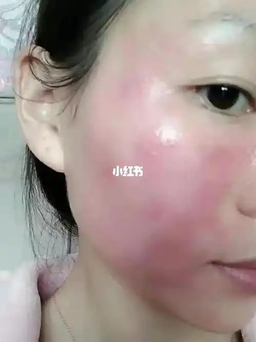 敏感肌大红脸的日子真心不好受