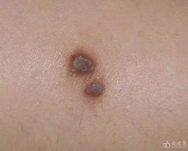 如何诊断----上肢皮肤结节