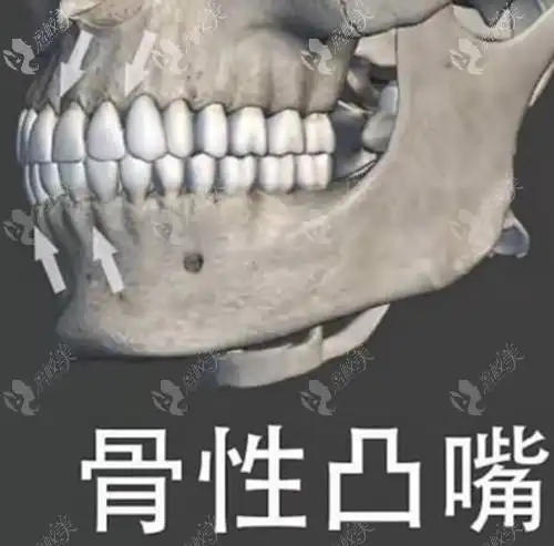 怎么判断嘴凸是骨性的还是牙齿的问题牙套能改善骨性凸嘴吗