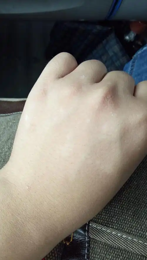 我这是白癜风早期证状吗?