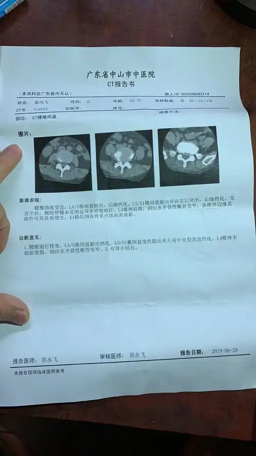 腰间盘突出ct图,请帮忙看下如何治疗好