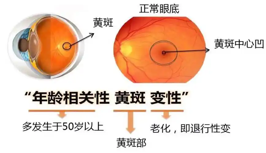 黄斑变性,偷走老年人视力的小偷_叶黄素_视觉_视网膜