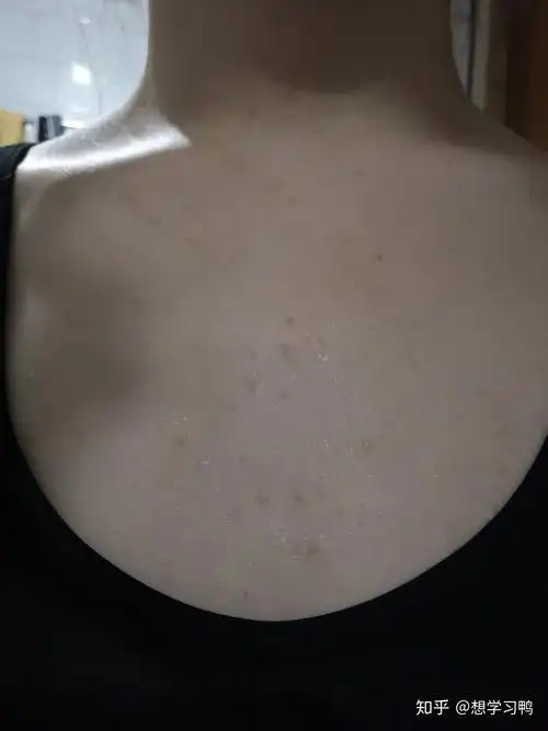 治好了扁平疣简直是我2019年最开心的事儿了希望对受此困扰的人有帮助