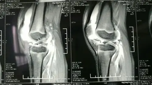 胫骨髁间嵴骨折一例