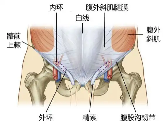 腹股沟斜疝是腹腔内的脏器由腹股沟管的内环口突出,进入腹股沟管