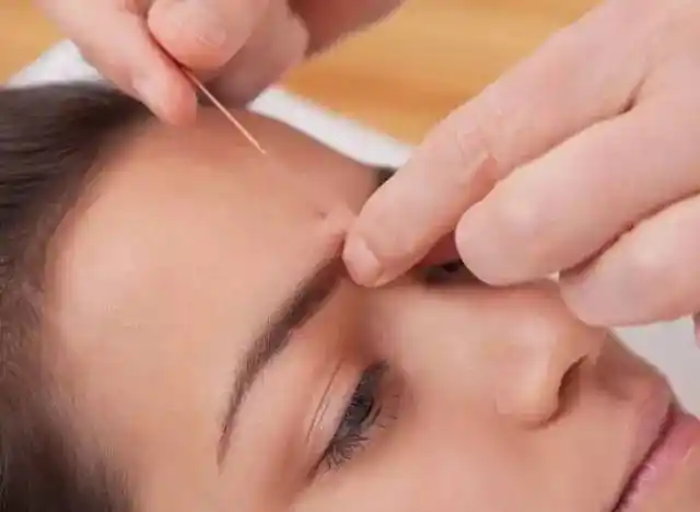 顽固性面瘫针灸治疗