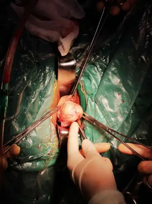 写美篇全科术前讨论,患者肌瘤前方紧邻膀胱,两侧紧邻子宫动脉及输尿管