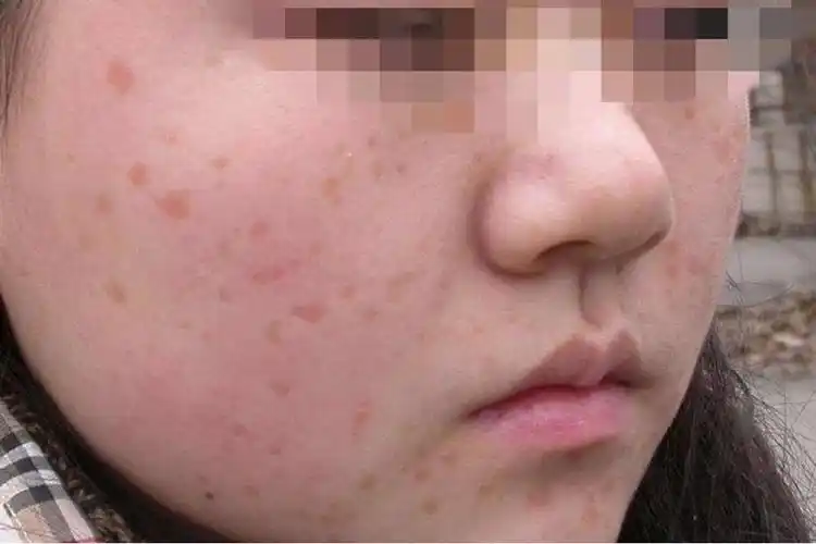 中国医科大学附属第一医院「三级甲等」 皮肤科概述脸上的疣通常表现