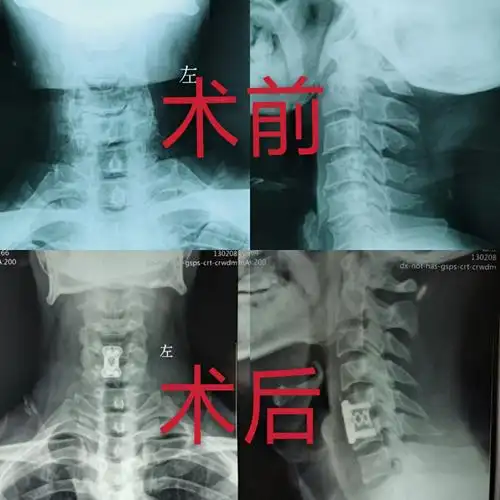我院骨科成功完成一例高难度颈椎病手术