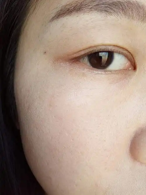 求帮忙啊,23岁眼睛下面明显细纹,肿么办