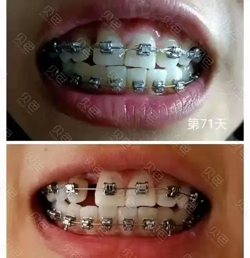 整牙前必知的牙齿矫正的好处与弊端,附牙齿正畸价格费用