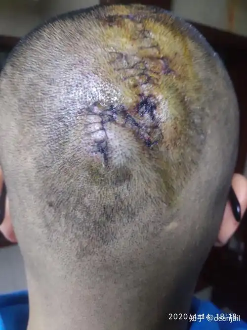 头皮手术中,皮瓣转移和埋扩张器两种方法产生的疤痕哪个更大? - 知乎
