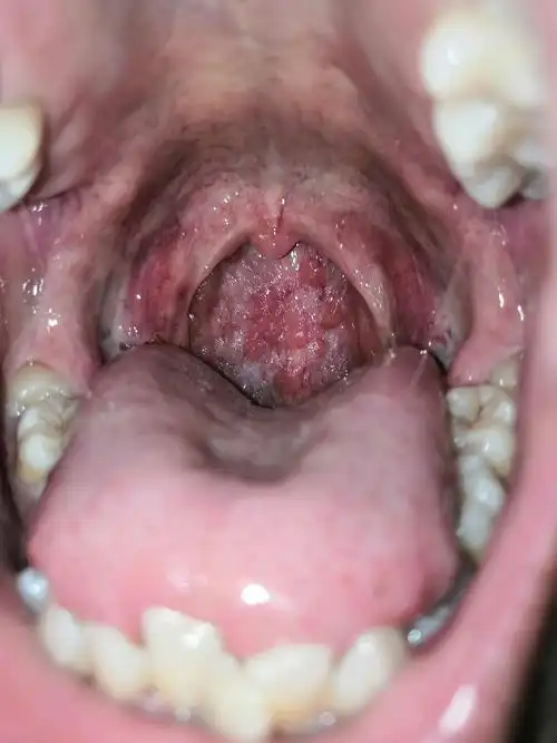 小时候经常生病,扁桃体发炎割了一次.现在每年喉咙还要疼几次.