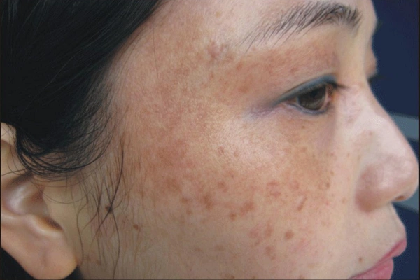 真皮斑和黄褐斑的区别