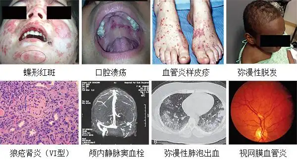 正确认识儿童系统性红斑狼疮