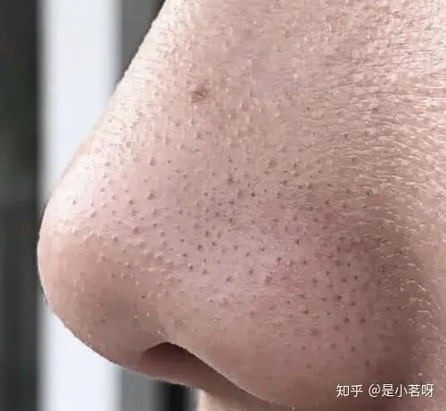 实际上黑头和白头并无本质区别,它们都是毛孔里的油脂粒.