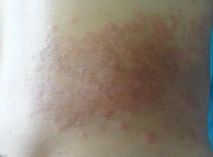 带状疱疹后原部位皮炎1例