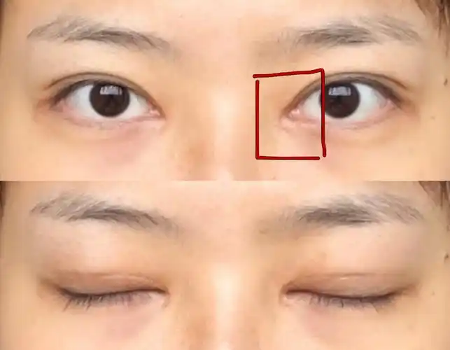 想问一下有没有开了眼角后包不进去的