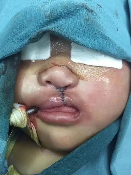 先天性唇裂宝贝手术前后对比照片