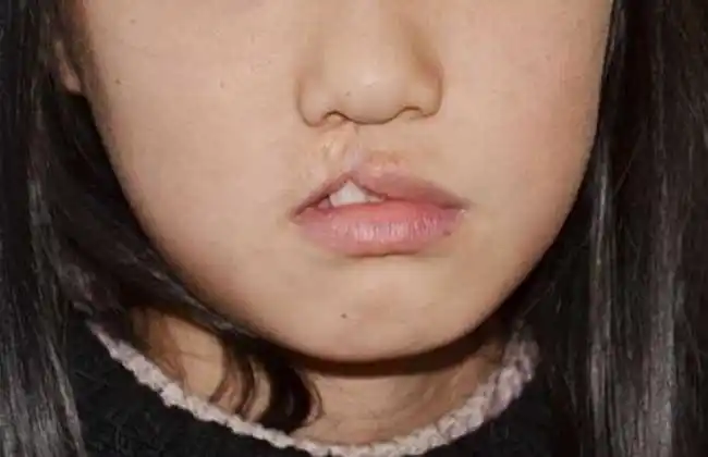 兔唇是怎么形成的