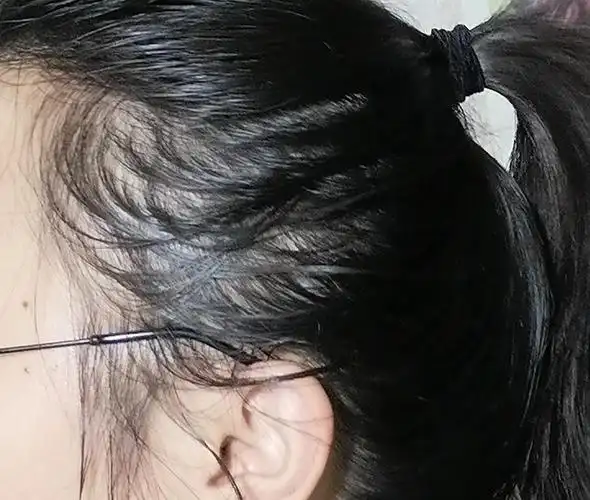 头发变得细软容易断,,还蓬松,,,两侧面头发更少,,,我才大二