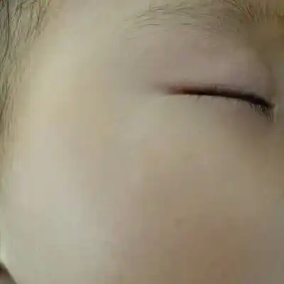 7个半月宝宝脸上有3-4个白点怎麼回事?