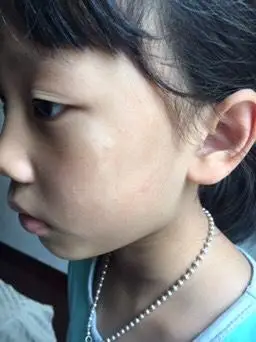 大家看看,孩子脸上的是不是白色糠疹啊!