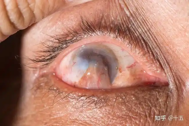 比起青光眼白内障这些眼病,翼状胬肉治疗是很简单的,做个小手术切除这