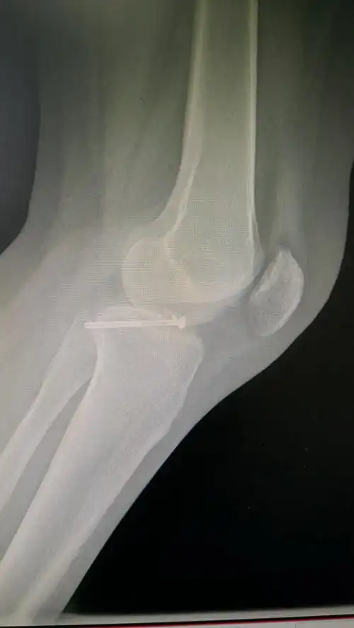 胫骨平台髁间脊骨折病例201811 - 好大夫在线