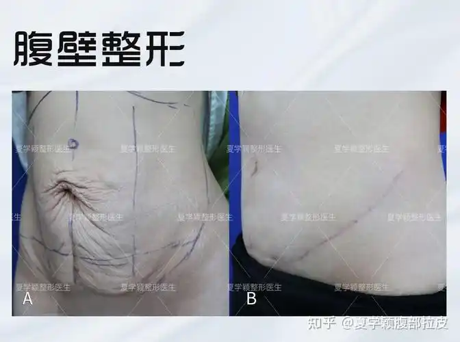 具有10余年产后即刻腹壁成形经验夏学颖腹部拉皮