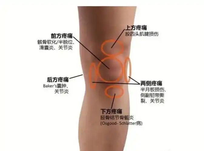 膝关节疼痛自我判断