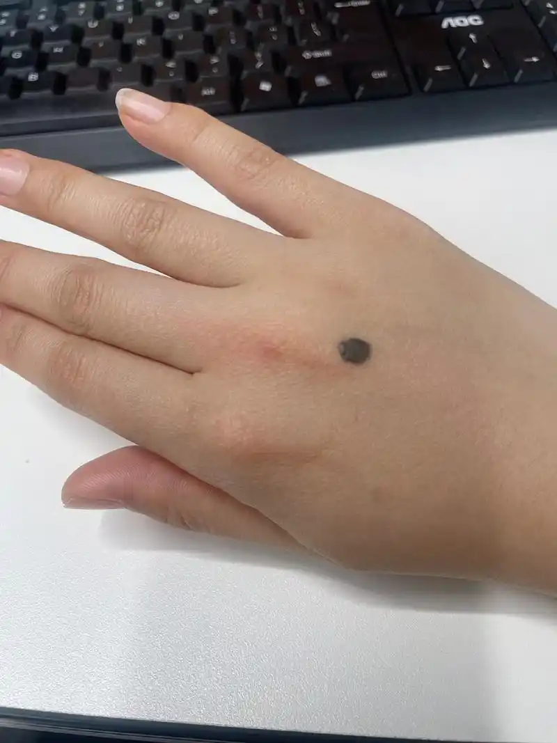 黑色素瘤 姐妹们这是黑色素瘤吗 很小的时候长得不是天生的 如果要动
