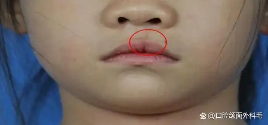 唇腭裂在临床上比较常见,每700个婴儿中就约有1个患有唇腭裂,这是一种