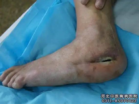 慢性骨髓炎症状__河北中医骨病医院