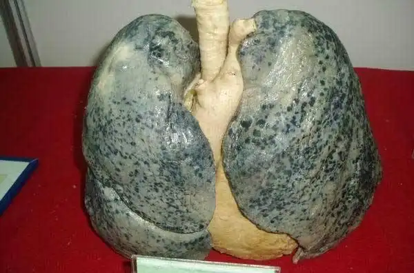 100个肺癌病人90个是烟民!吸烟三十年会少活多少年?