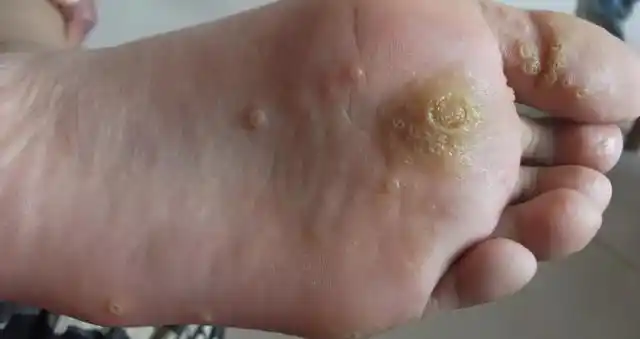 hpv到底是什么?很多女性都有感染过,但却很少人了解